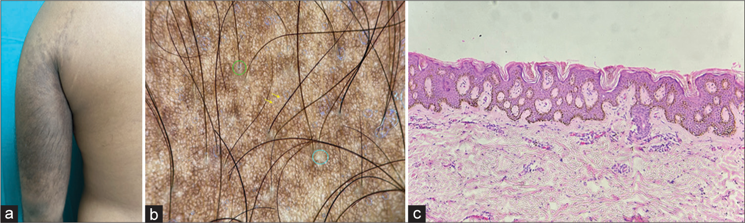 Dermoscopy of Becker’s nevus in two cases