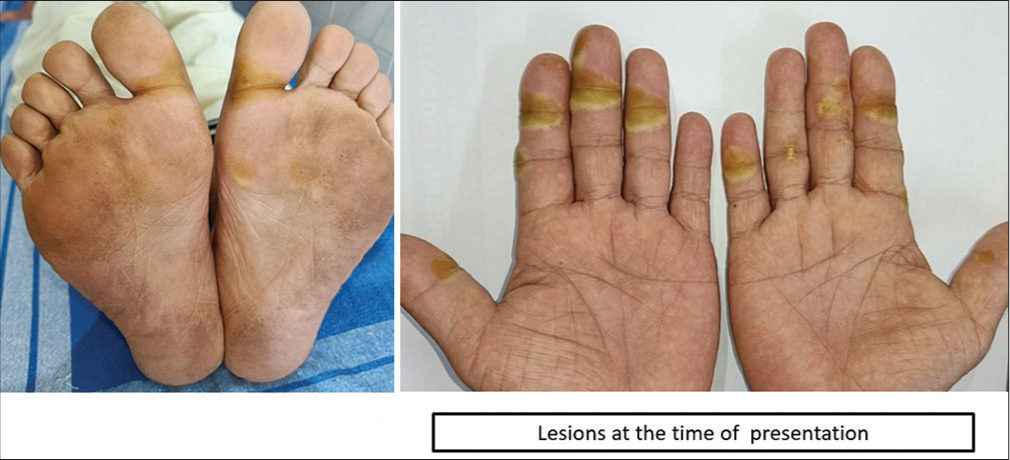 A rare case of blistering distal dactylitis in an adult