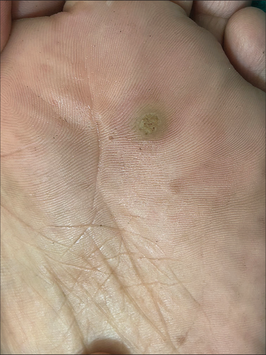 Dermoscopy of plantar wart