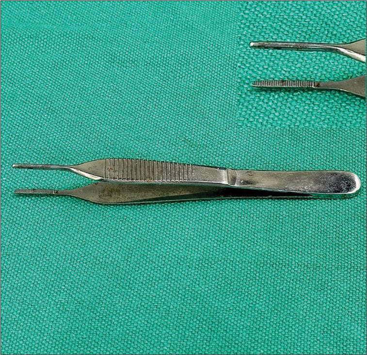 Enhancing precision in a complete earlobe tear repair with Adson’s forceps