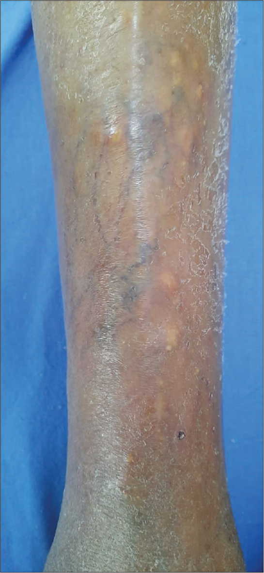 Miliary gout: A rare case report from North India