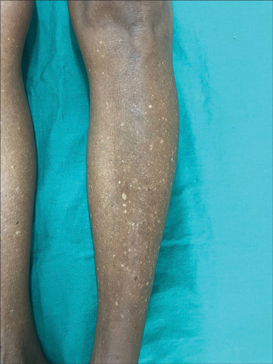 Clinical and dermoscopic patterns of idiopathic guttate hypomelanosis