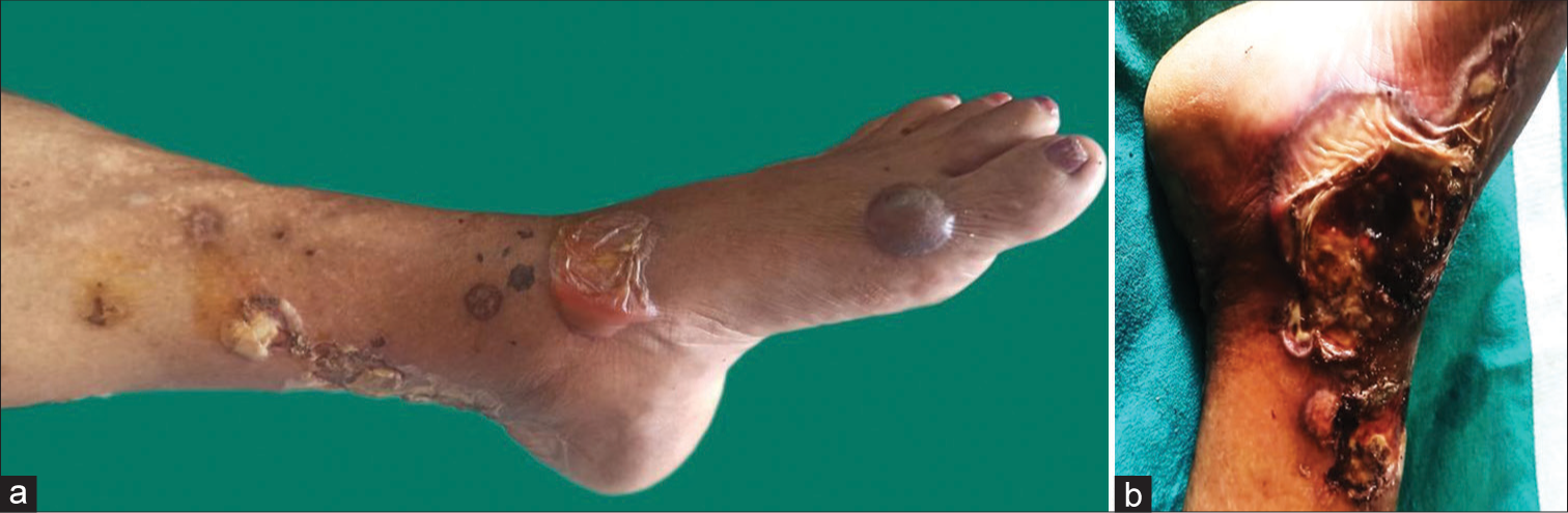 A double whammy of bullous pyoderma gangrenosum and deep vein thrombosis following COVID-19 infection