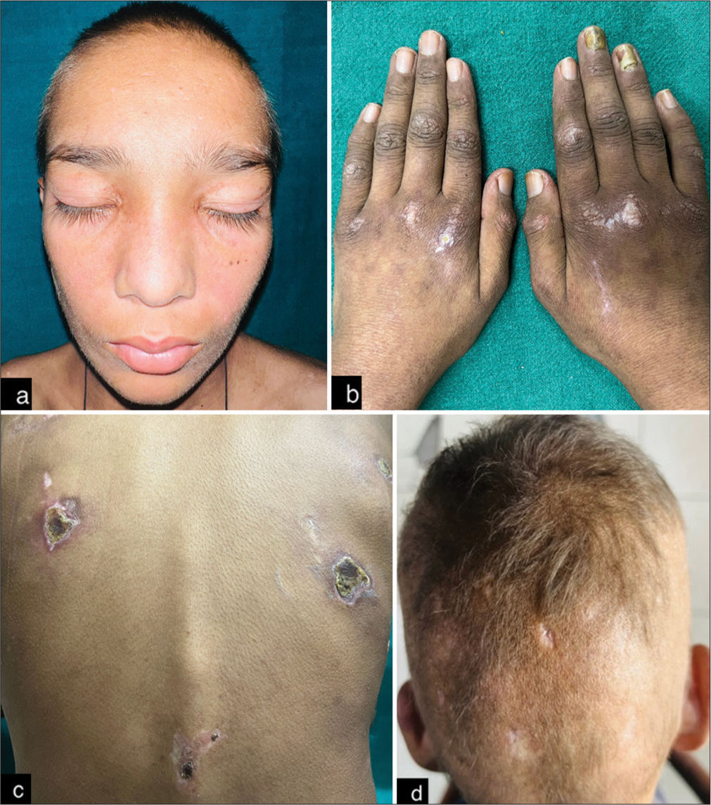 Overlap syndrome: Juvenile dermatomyositis with systemic lupus erythematosus and lupus hepatitis in a child: An uncommon presentation