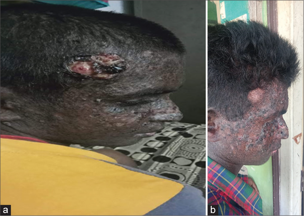 Trichilemmal cyst with xeroderma pigmentosum in pediatric patient – A case report with review of the literature