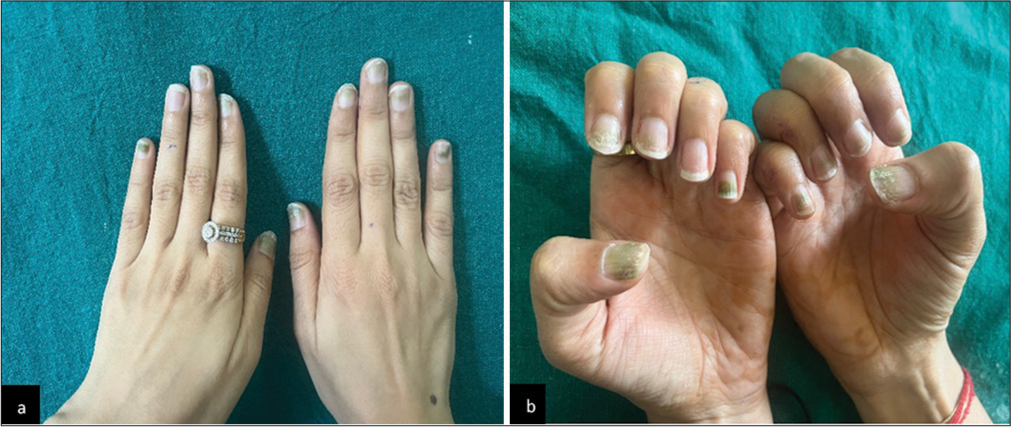 Greenish discoloration due to gel nail extensions mimicking Pseudomonas aeruginosa infection: Is beauty really worth the risk: A case report