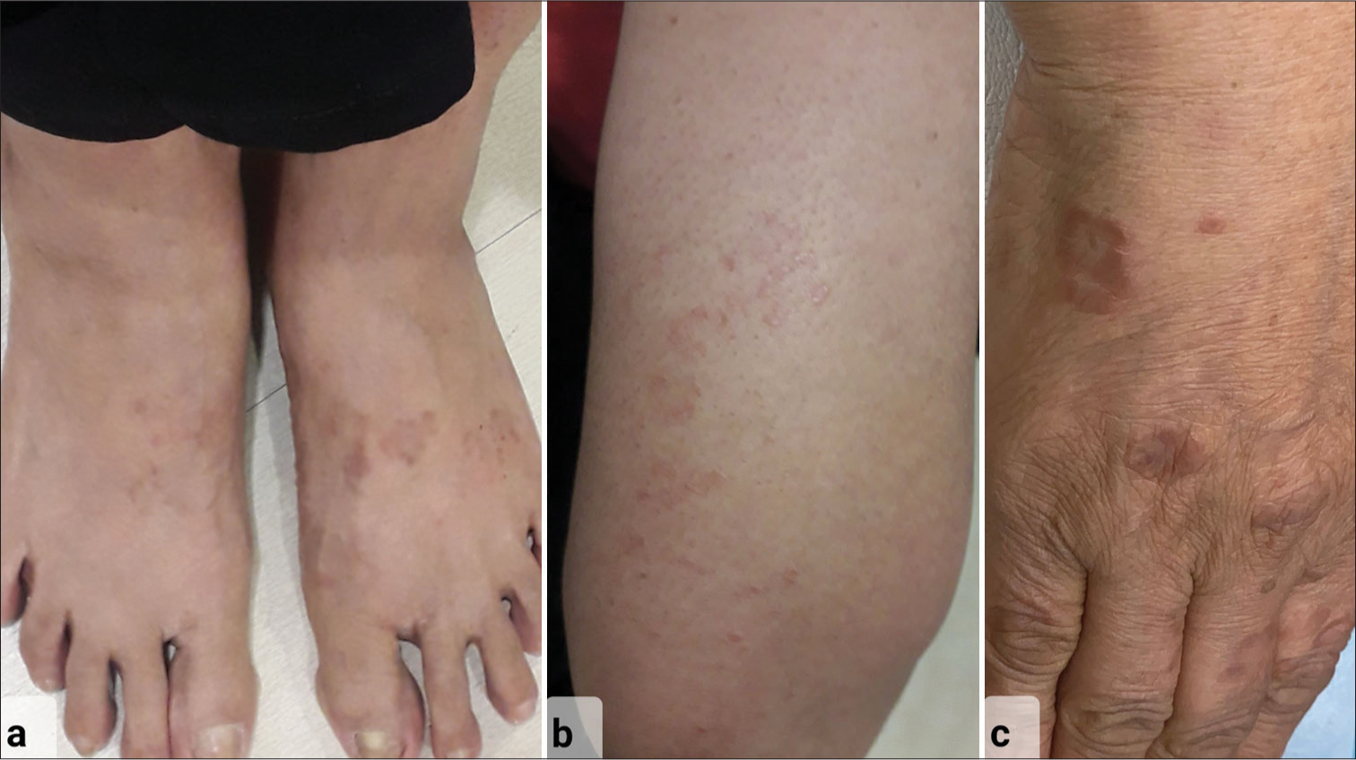 Tofacitinib in a case of generalized granuloma annulare: A two-year follow-up of relapse and remission