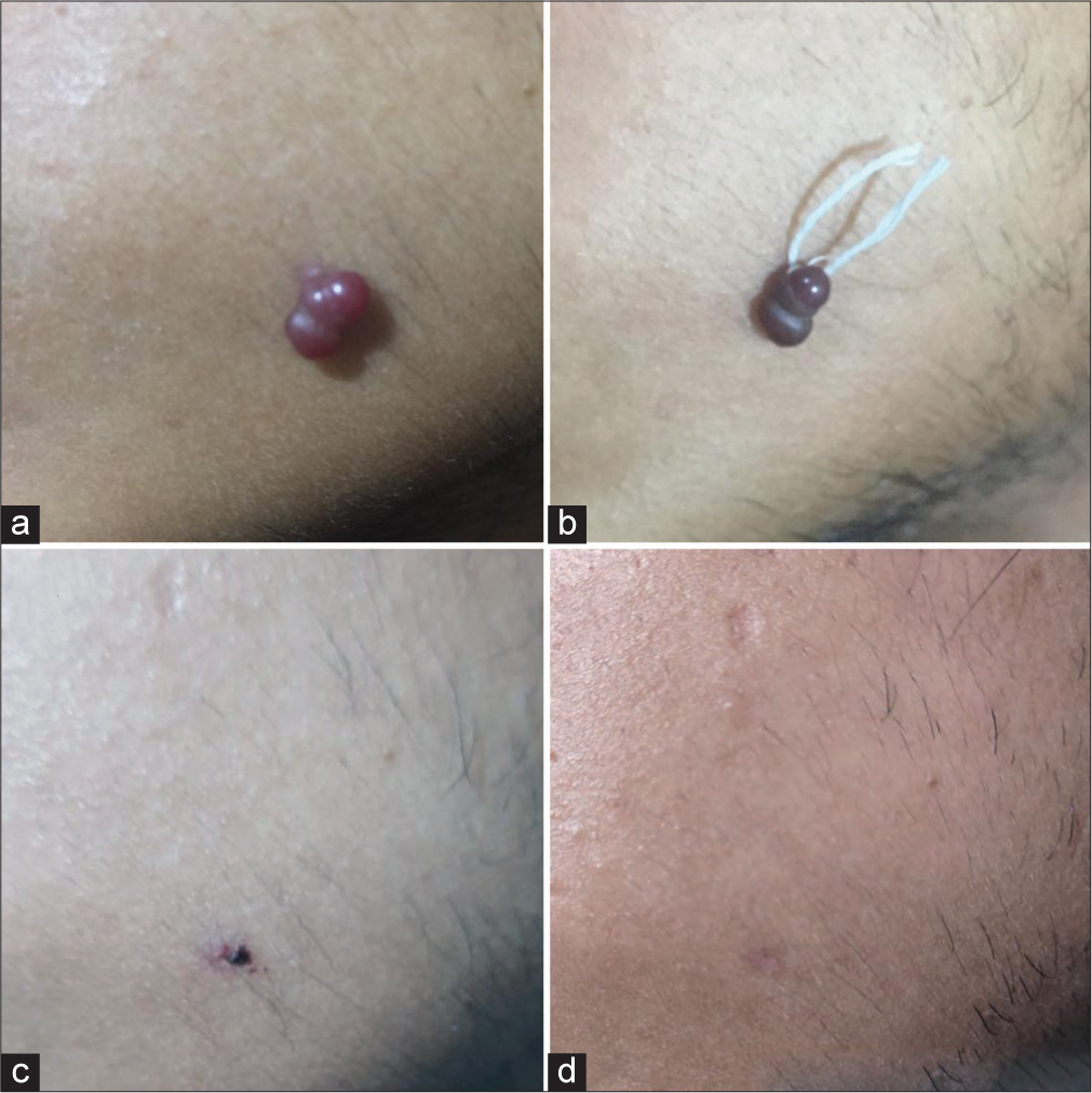 Surgical pearl: A simple, fast, and less hemorrhagic technique of ligation for treating pedunculated granuloma pyogenicum