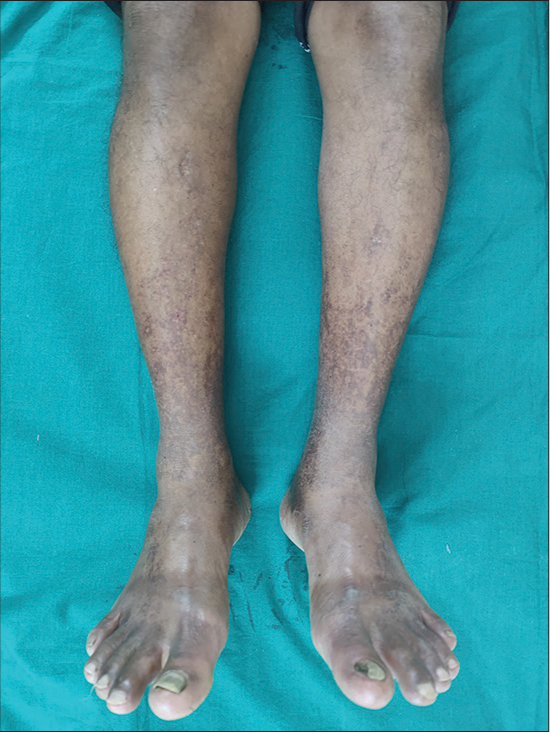 Pigmented purpuric dermatosis: A dermoscopic and management perspective