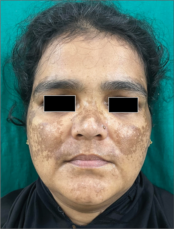 Facial dyschromias: A review of clinical and dermoscopic features