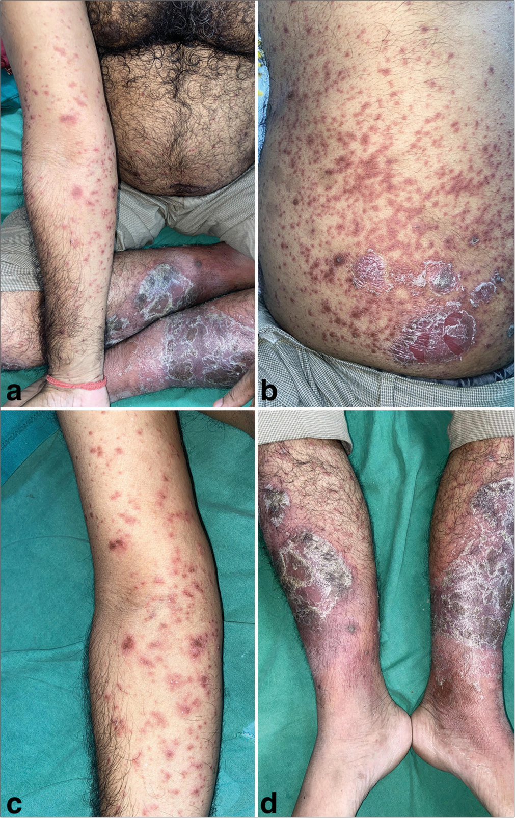 Pustular exacerbation of psoriasis precipitated by erythema multiforme like pityriasis rosea