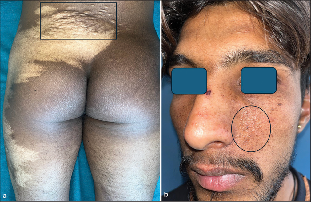 Cutaneous mosaicism: Segmental nevus depigmentosus with tuberous sclerosis