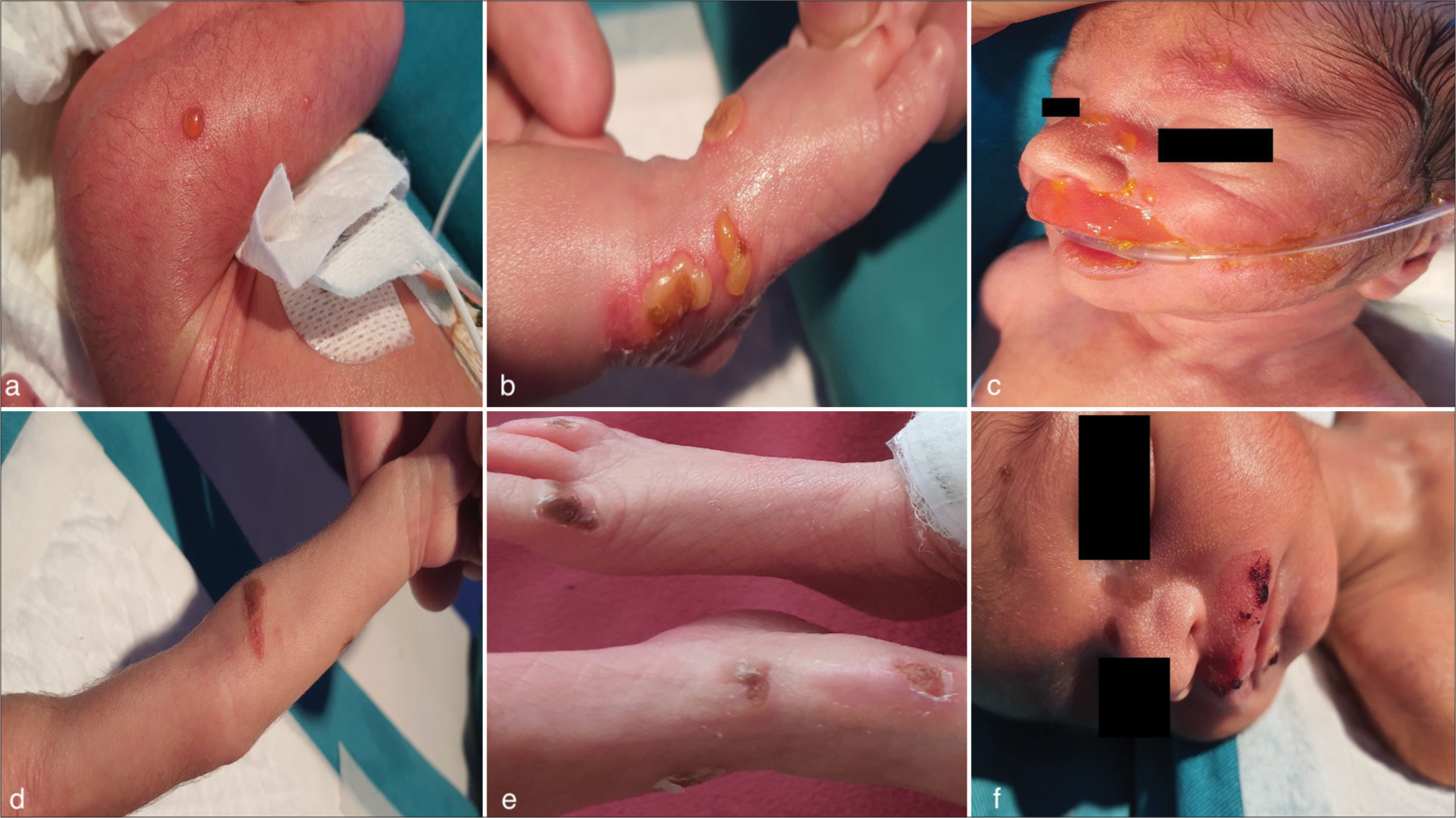 A rare case of progressive neonatal pemphigus vulgaris treated successfully with intravenous immunoglobulin