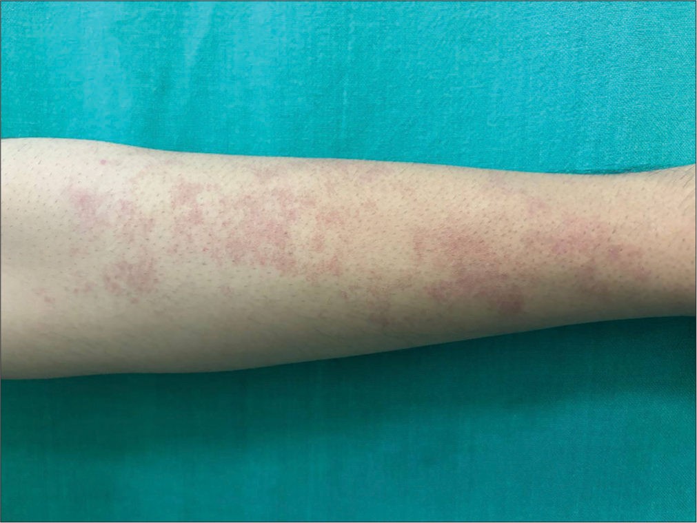 Angioma serpiginosum: A rare vascular anomaly with unique clinical and dermoscopic features