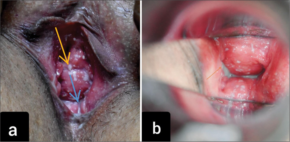 Coexistence of mixed vaginitis with cervicitis: A changing trend