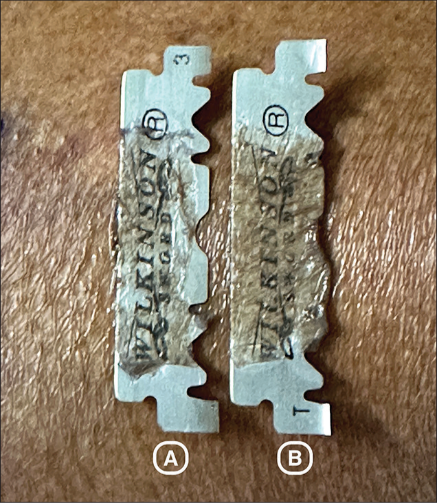 Comparison between Silver’s knife and Razor blade technique in harvesting ultrathin epidermal sheets; which one is better?