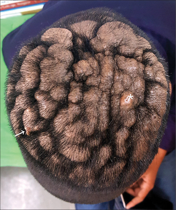 “Sulci and Gyri” on scalp: A visual presentation of cutis verticis gyrata