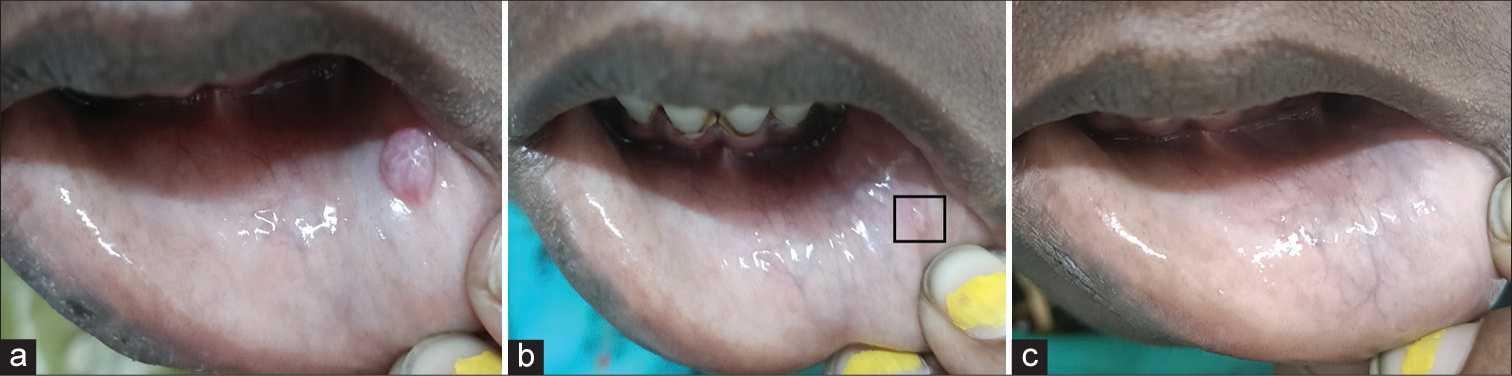 Successful treatment of oral mucocele with sclerotherapy