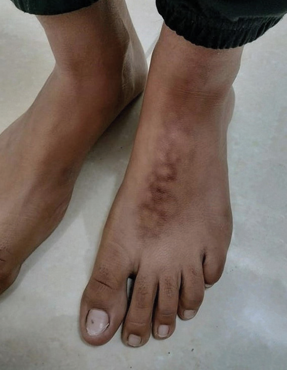 Mottled rash on the dorsal feet of an adolescent girl