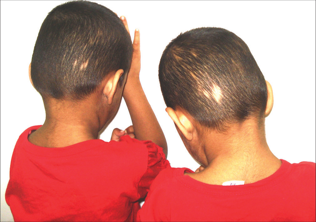Mirror-image alopecia areata in mirror-image twins