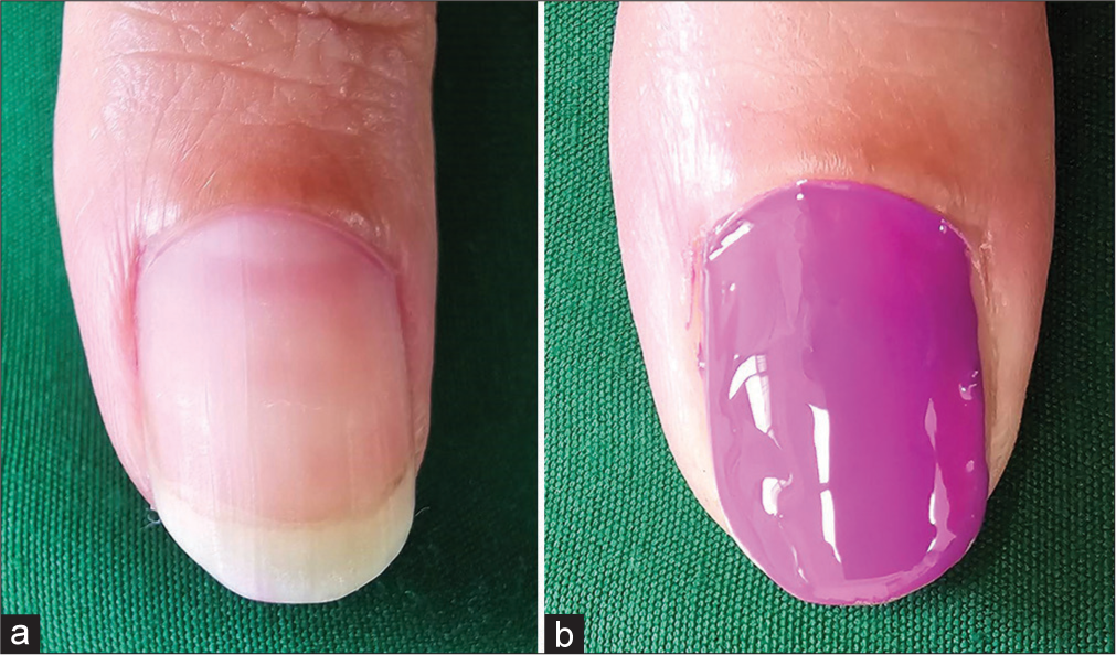 Adverse effects of nail cosmetics and how to prevent them