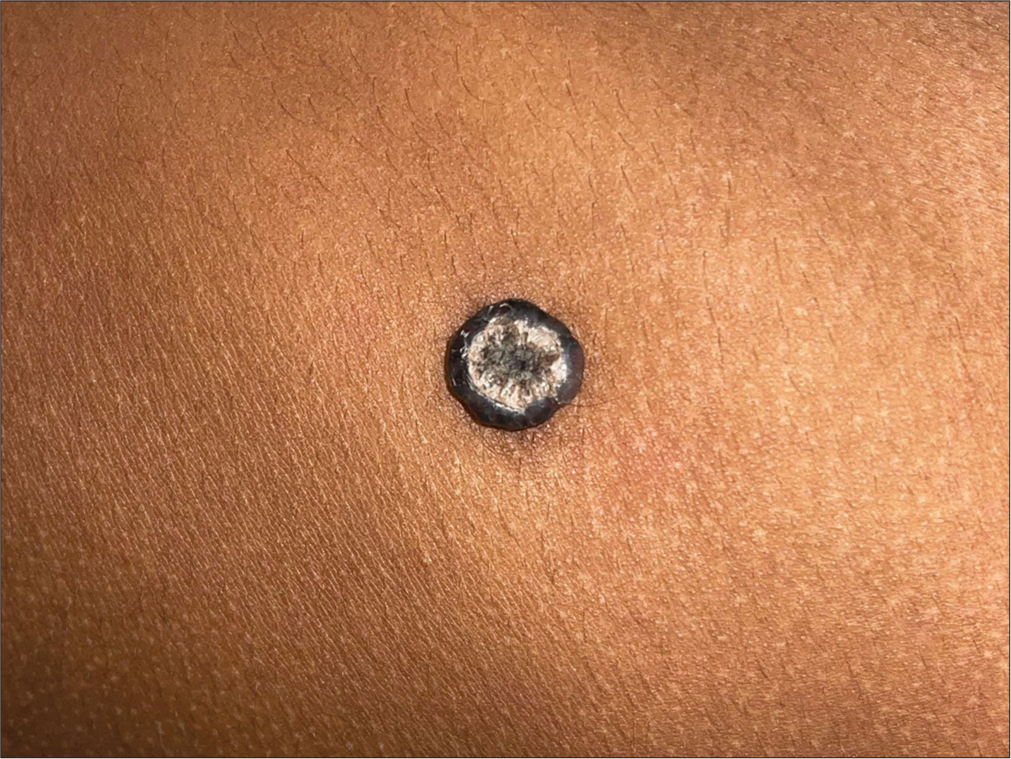 Nodular basal cell carcinoma in a young female at an unusual site – A rare presentation
