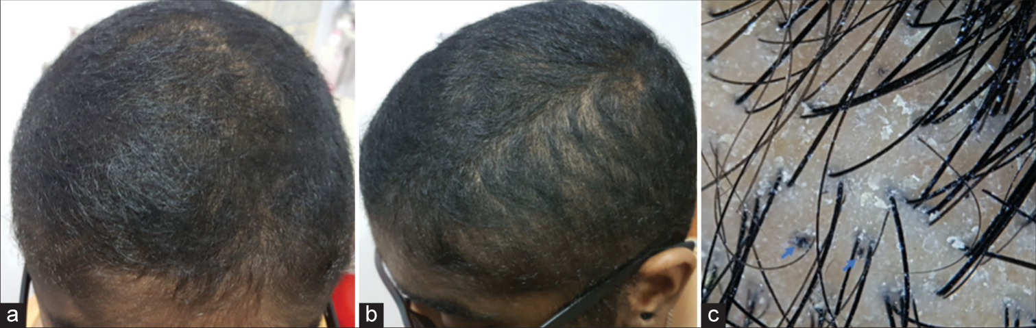 A case of loose anagen hair syndrome associated with trichotillomania in a 14-year-old girl