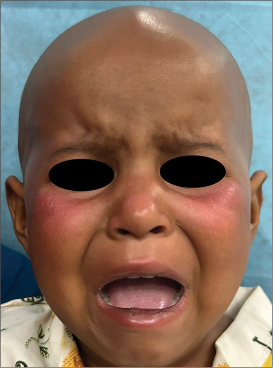 Ara-C face: A malar rash
