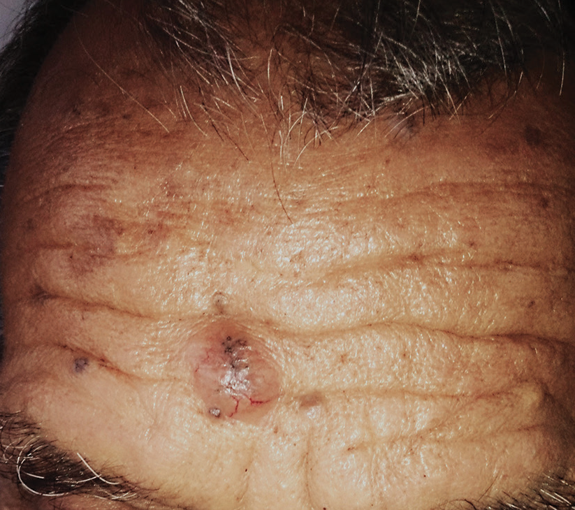 Skin-colored nodule on the forehead with telangiectasia