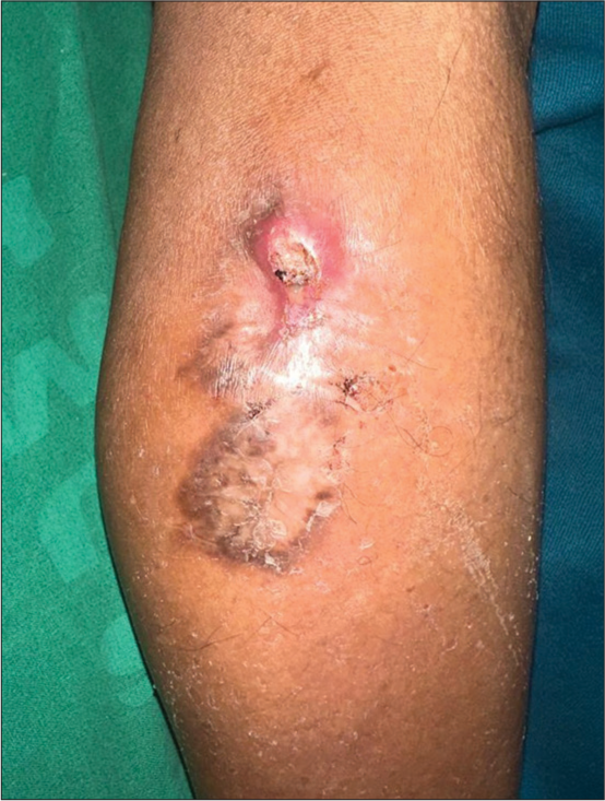 Primary cutaneous actinomycosis manifesting as pyomyositis: A diagnostic challenge