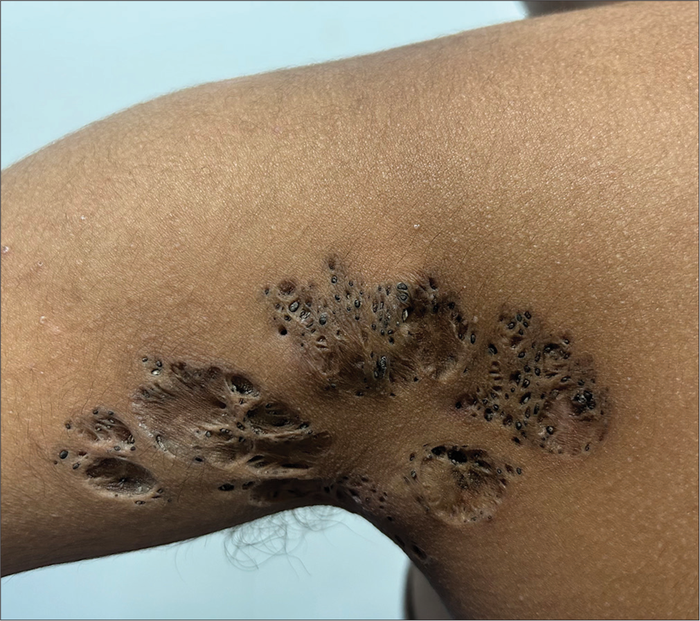 Nevus comedonicus: Clinical and dermoscopic features