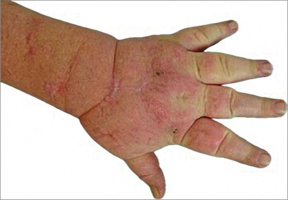 Lymphedema after COVID-19 vaccination: Two case reports