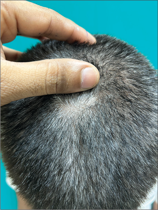 Role of dermoscopy in differentiating seborrheic dermatitis of scalp and scalp psoriasis