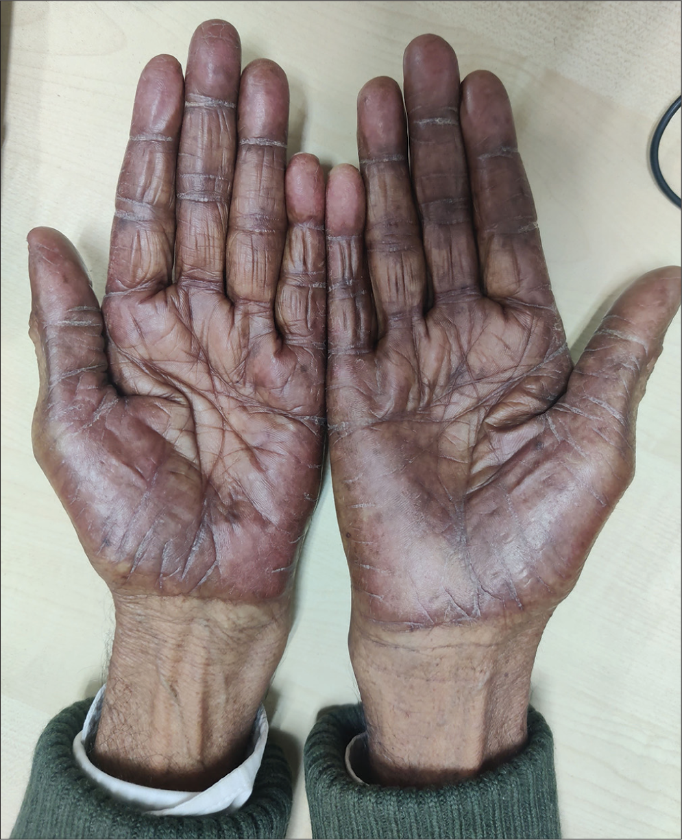 Capecitabine-induced palmar-plantar erythrodysesthesia