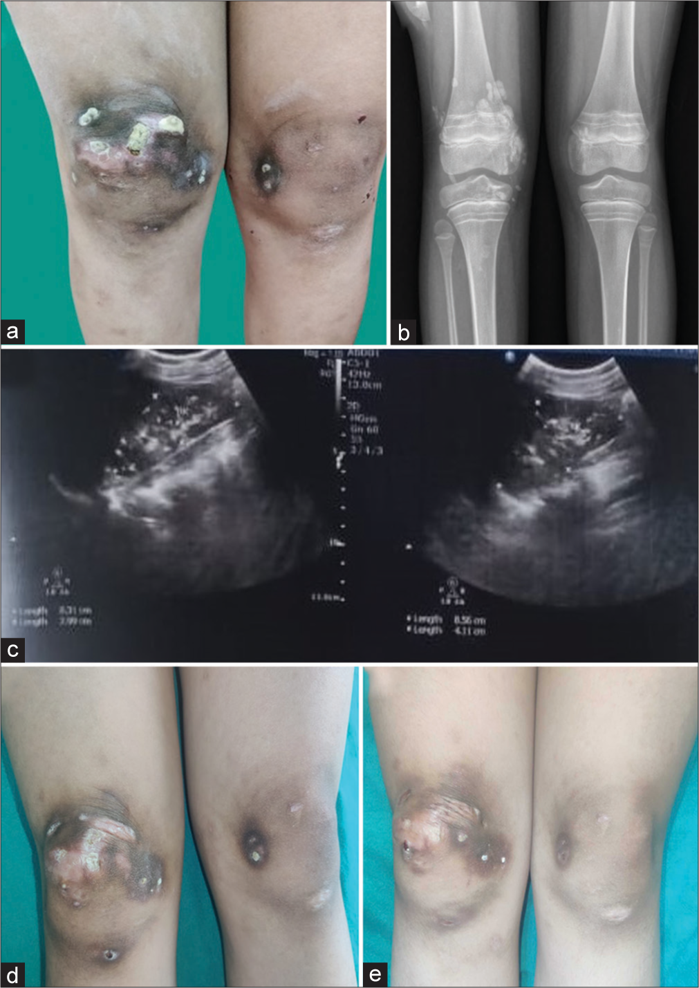 Calcinosis universalis in a case of juvenile dermatomyositis