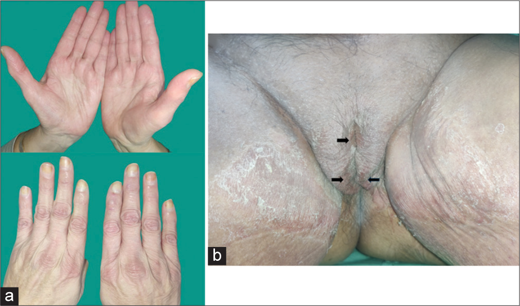 Hand-foot syndrome secondary to sorafenib in a case of breast carcinoma