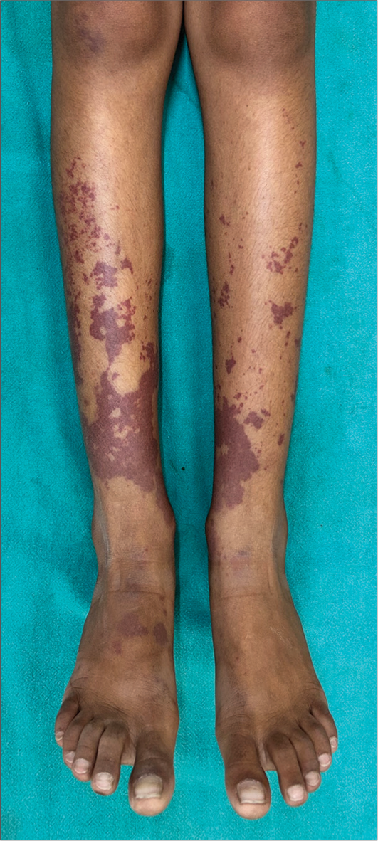 Dermoscopy-histopathology correlation of cutaneous small-vessel vasculitis