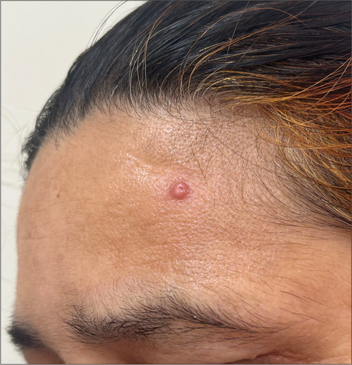 Dermoscopy of molluscum contagiosum with an orifice-single lesion in an adult