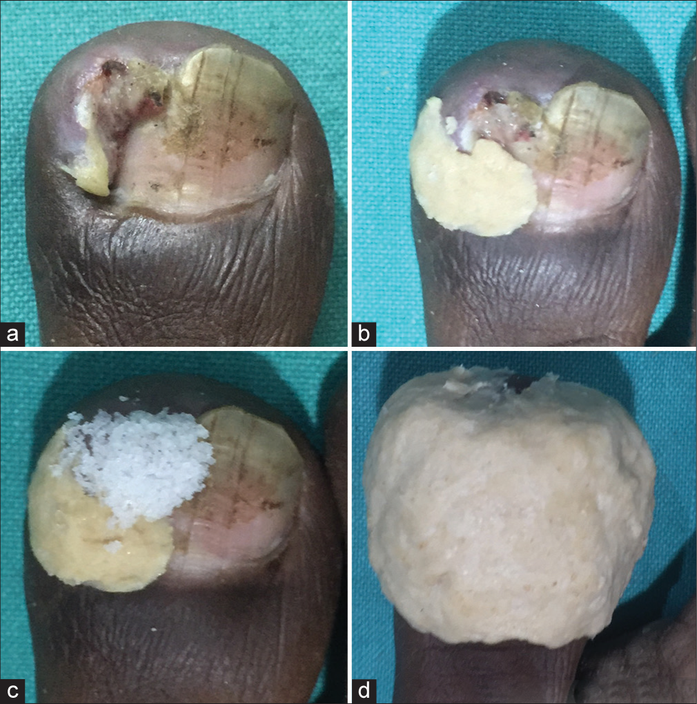 A novel use of table salt and wheat flour dough for treating pseudopyogenic granuloma