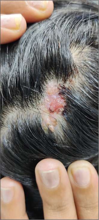 Verrucous outgrowth on scalp