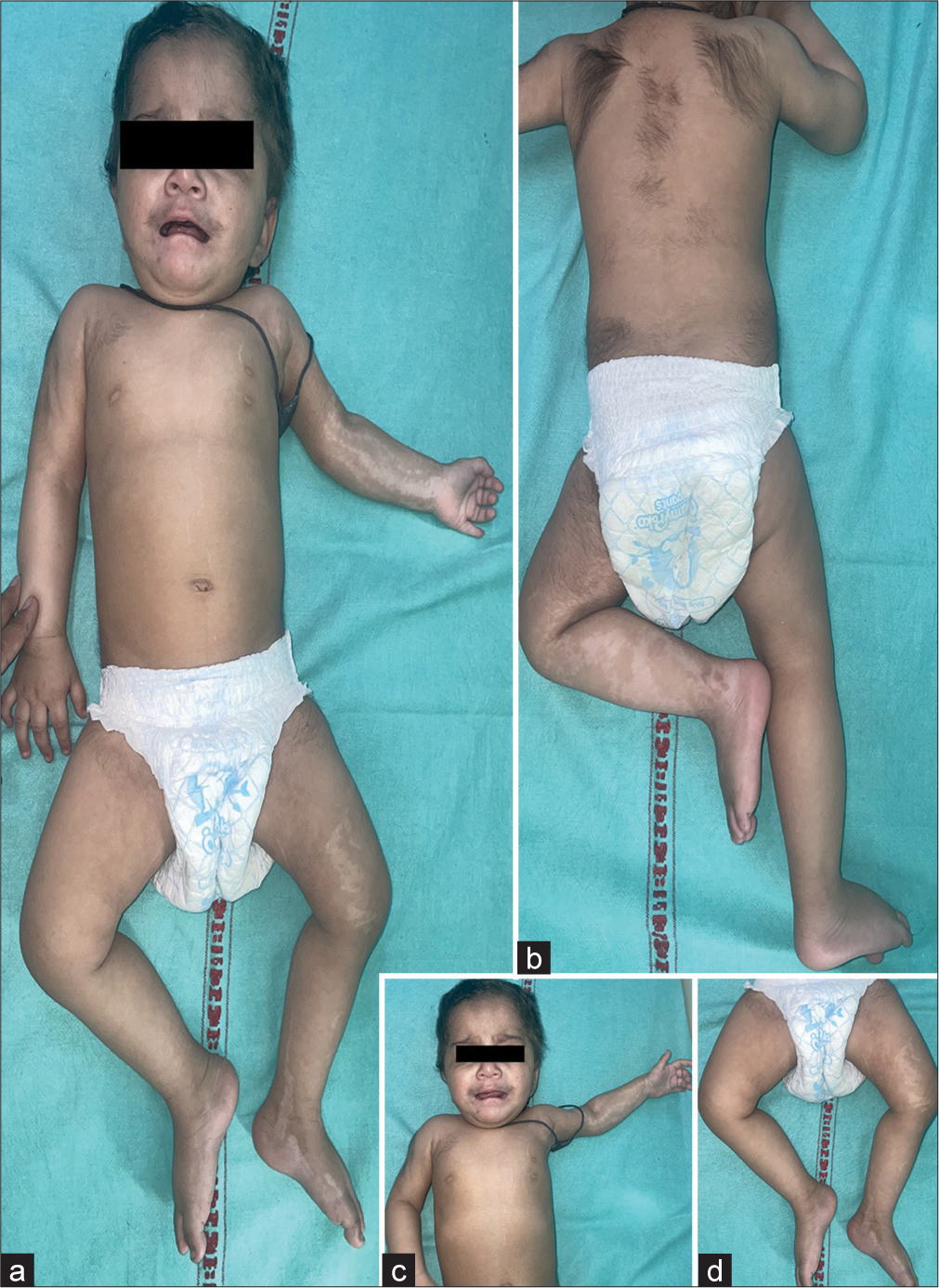 Differential mosaicism of hypertrichosis and hypomelanosis