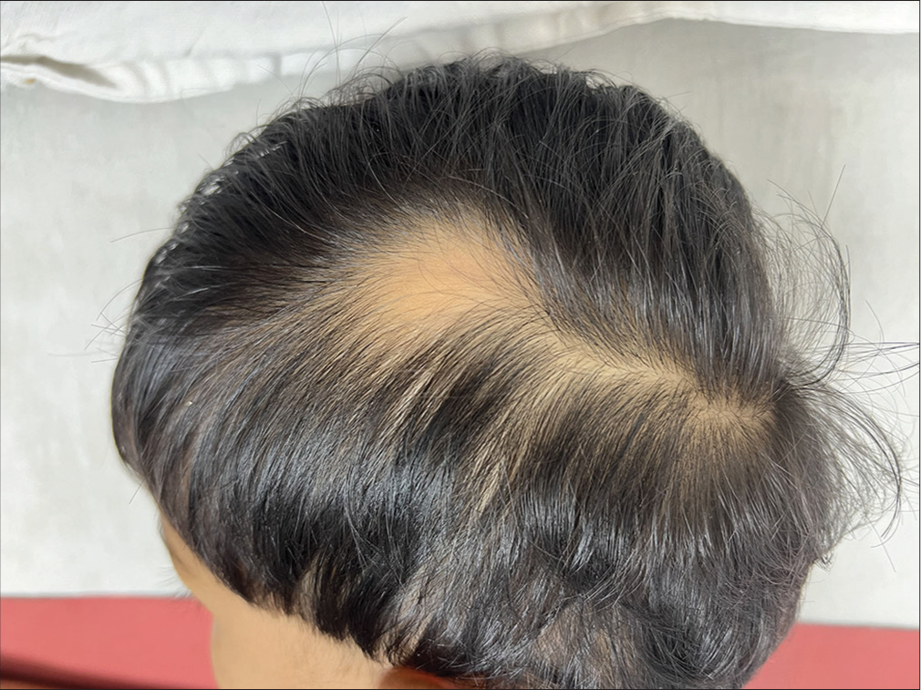 A case of congenital extratemporal non-triangular alopecia of the scalp: Need to revisit the conventional terminology