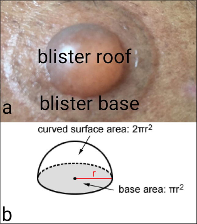 An insight: Geometrical relationship between suction device size and blister and its clinical importance