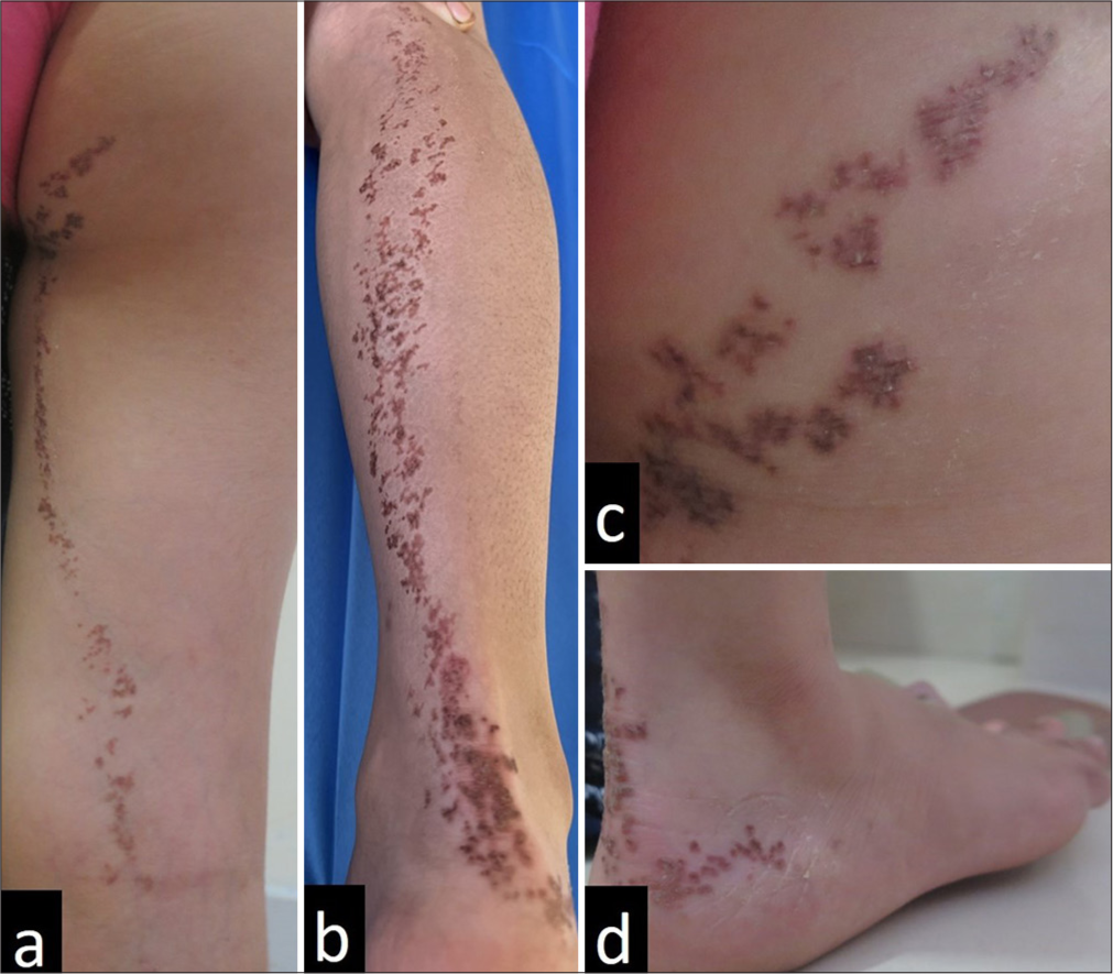 Linear porokeratosis and the rationale of combining calcipotriol with 5-fluorouracil