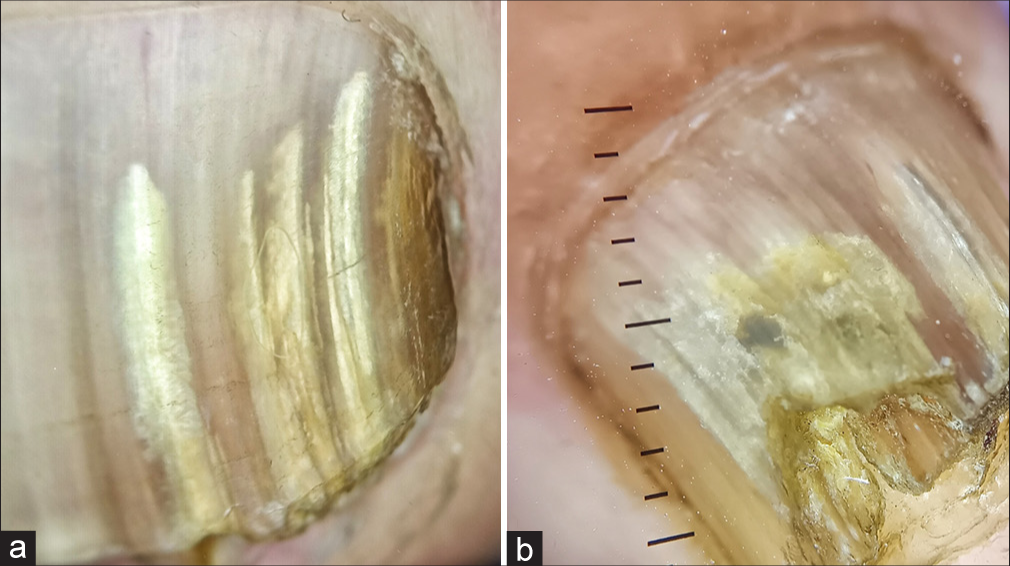 Aurora Borealis pattern: A clue to onychomycosis