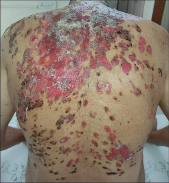 Pemphigus vulgaris post-coronavirus disease-19 infection: A case report and review of literature