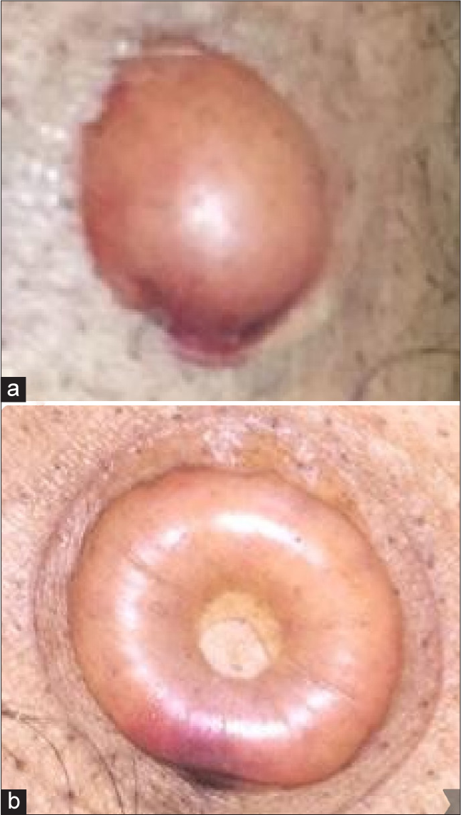 A simple technique for making an atraumatic airtight small disposable syringe suction device for epidermal grafting