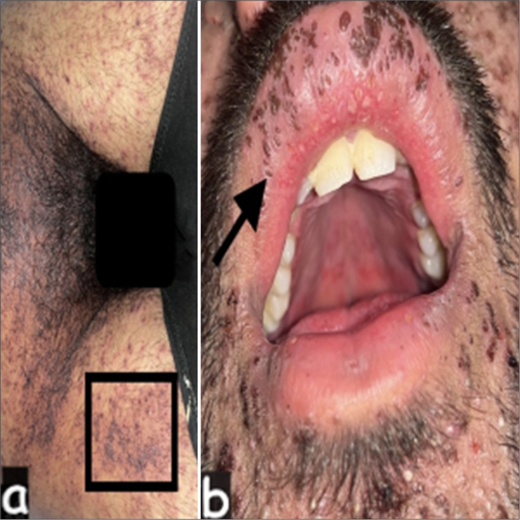 Atypical disseminated hemorrhagic varicella mimicking toxic epidermal necrolysis in an immunocompetent adult