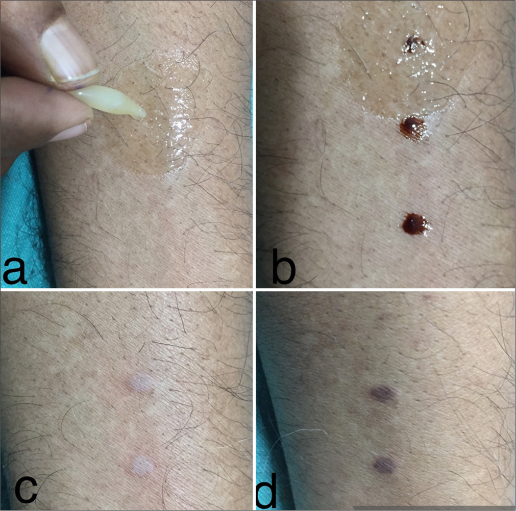 Novel use of chloramphenicol eye ointment for preventing eye injury during trichloroacetic acid cautery of xanthelasma palpebrarum