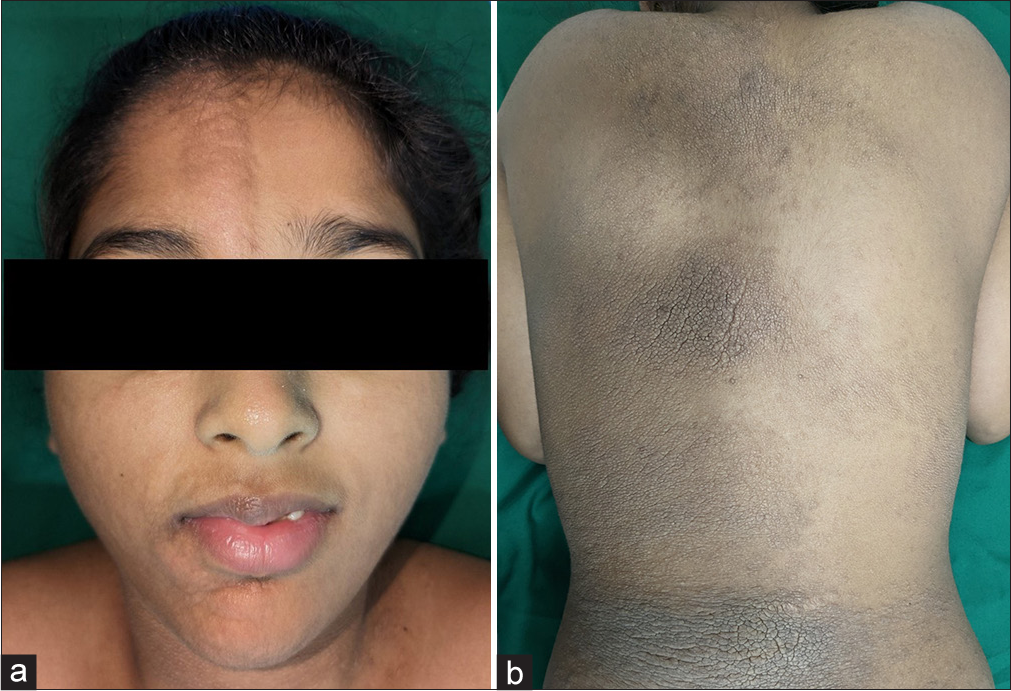 Systematized nevus lipomatosus